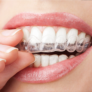 Dental Implants Dentist in Pleasant Hill CA