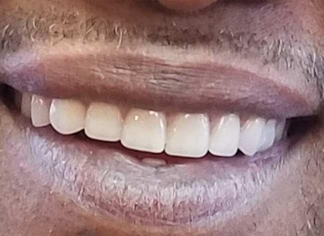 Diablo Valley Dental | Root Canals, Implant Dentistry and Invisalign reg 