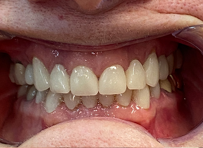 Diablo Valley Dental | Oral Cancer Screening, Sleep Apnea and Implant Dentistry