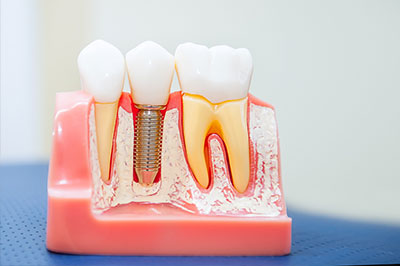 dental implants