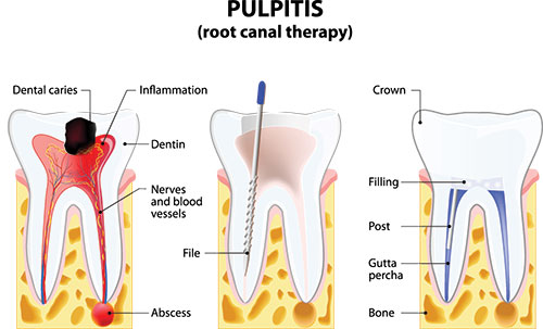 root canal