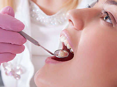 dental fillings